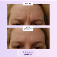 Scarlette™ Silicone Scar Sheets