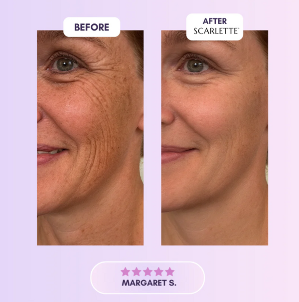 Scarlette™ Silicone Scar Sheets