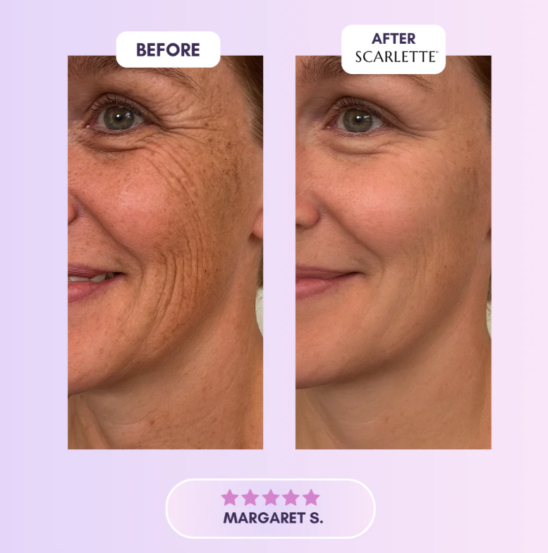 Scarlette™ Silicone Scar Sheets
