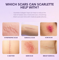 Scarlette™ Silicone Scar Sheets
