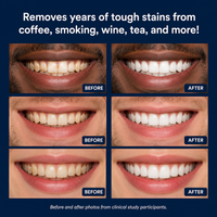 Dr. Nuro Teeth Whitening Pen